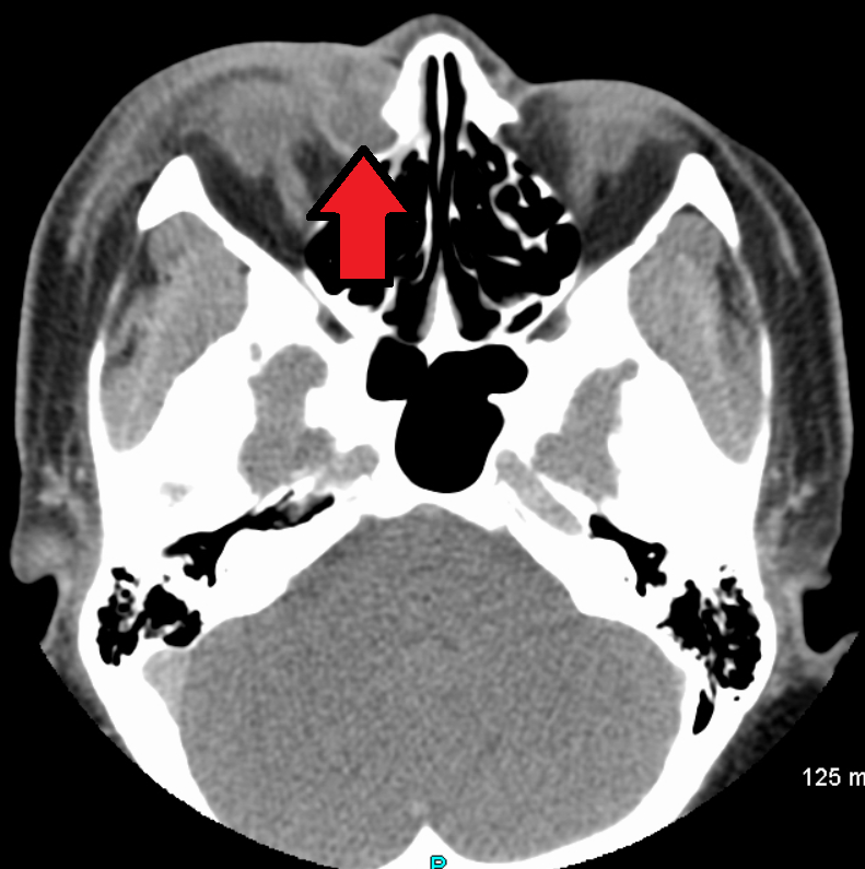 Acute dacryocystitis with swelling at medial canthus