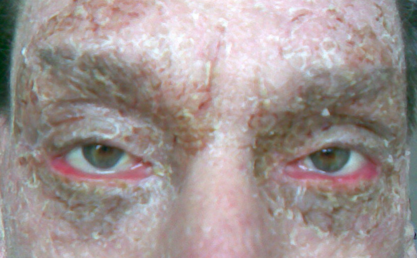 Cicatricial ectropion