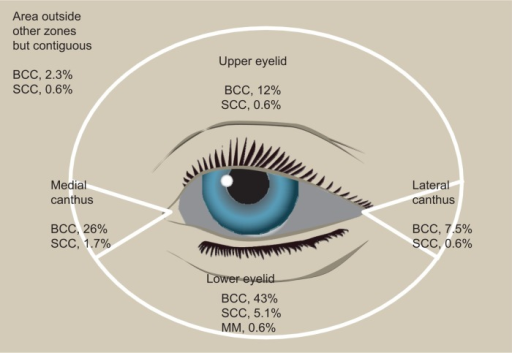 Location of <b>eyelid</b> <b>malignancies</b>: percentages for 174 <b>tumors</b>.Notes: Reprinted by permission of Mayo 