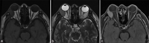 (a-c) Magnetic resonance imaging (MRI) examination of the orbit showed that the right <b>lacrimal gland</b> was enlarged