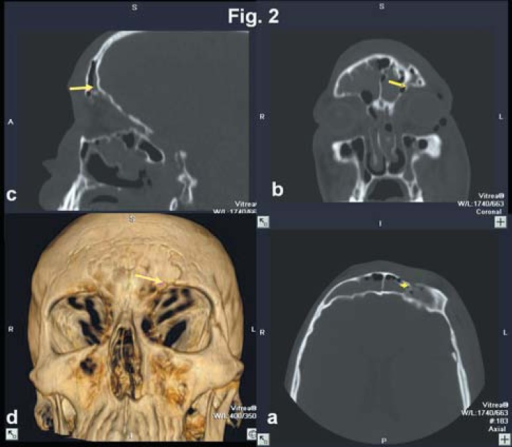CT images of orbital fracture including coronal, sagittal, axial views and 3D reconstruction showing orbital wall fracture