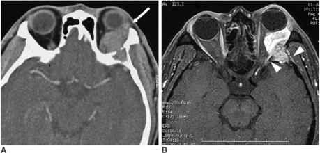 Adenoid cystic carcinoma: contrast-enhanced CT and gadolinium-enhanced MRI showing lacrimal gland tumor with intracranial extension