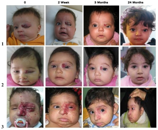 Capillary hemangioma: clinical photographs of infants with eyelid capillary hemangiomas before and after propranolol treatment