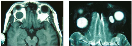 Cavernous hemangioma: T1 and T2-weighted MRI showing well-defined intraconal masses in bilateral orbits with marked uniform enhancement