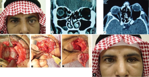 Dermoid cyst: clinical photograph and CT/MRI of orbital dermoid cyst causing painless proptosis