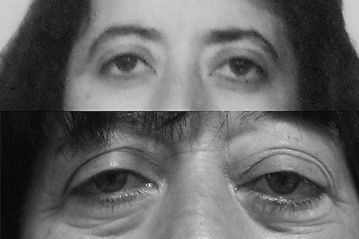 Orbital lymphoma: clinical photograph showing slowly progressive left proptosis over 15 years