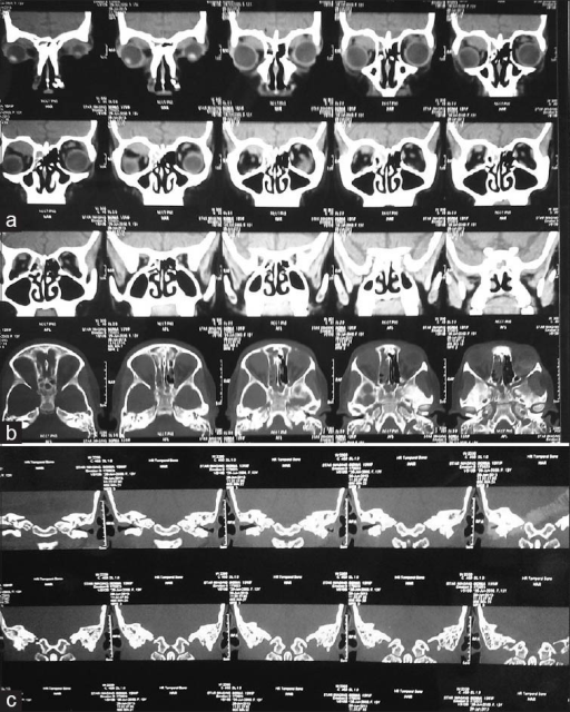 Rhabdomyosarcoma: contrast MRI showing isointense infiltrates with bilateral proptosis in a child