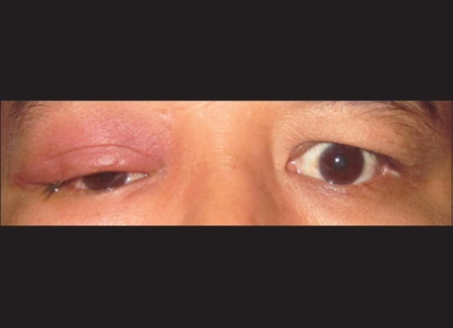 Clinical photo showing <b>preseptal cellulitis</b> of the right eye (Case 1)