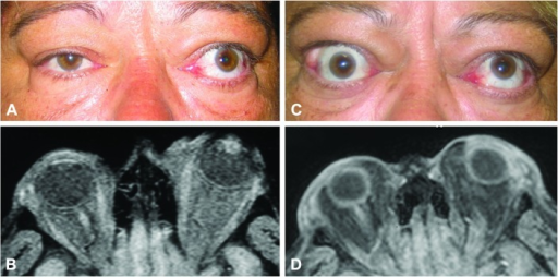 Clinical photographs showing proptosis and conjunctival injection in thyroid eye disease, with coronal MRI demonstrating extraocular muscle enlargement