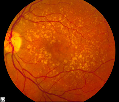 Intermediate age-related macular degeneration fundus photograph