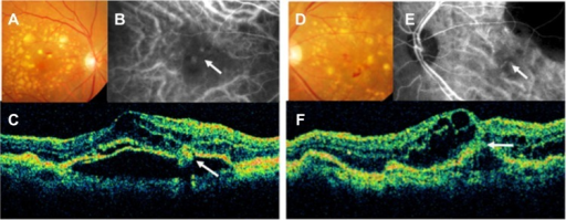 Retinal angiomatous proliferation (RAP) multimodal imaging — fundus, ICG, OCT