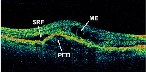 OCT showing subretinal fluid, macular edema, and pigment epithelial detachment in wet AMD