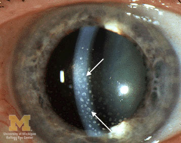Keratic precipitates in anterior uveitis