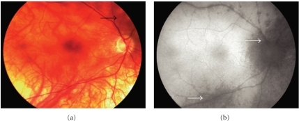 Images from the right <b>eye</b> of a 69-year-old woman with <b>birdshot chorioretinopathy</b> (patient 6). (a) Fundus p