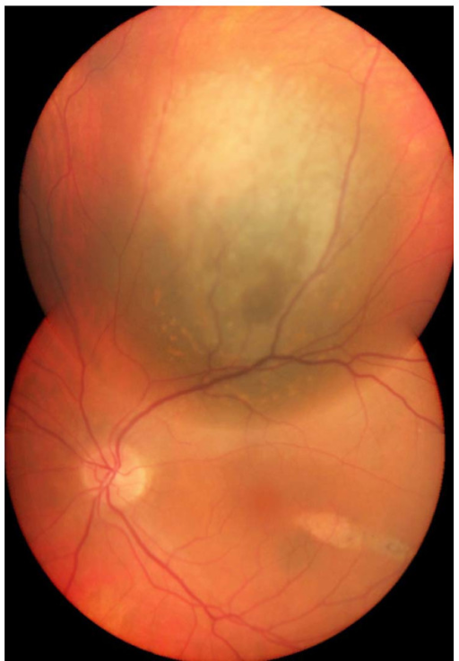 Ocular fundus image of the <b>choroidal melanoma</b>. Clinical appearance of the <b>choroidal</b> mass after receiving e