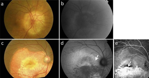 Color fundus photographs and FAF findings of case 1 (a, b) and case 2 (c, d), and FA of case 2 (e). Both cases had a <b>