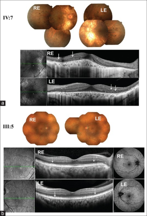 맥락막결손의 안저사진 및 OCT 소견