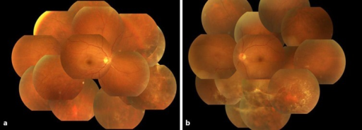 Preoperative fundus photographs obtained on initial examination. a Right eye. b Left eye. a Yellowish-white granular exu