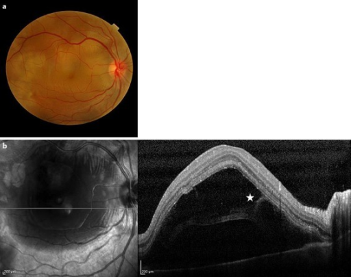 a Right-eye fundus at the initial examination, showing an <b>exudative retinal detachment</b>. b SD-OCT scans of the rig