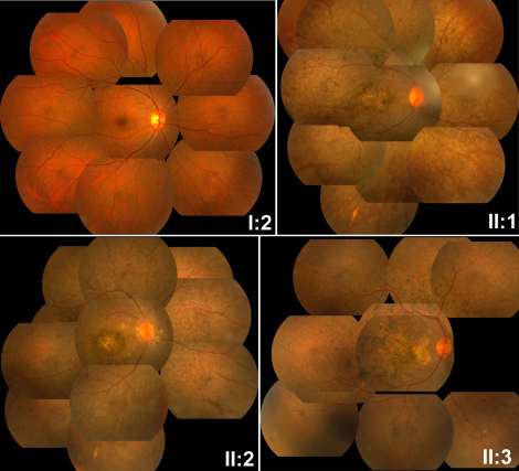 Fundus photos of the four members of the family. The mother (I:2), with digenic mutations, had a normal fundus appearanc