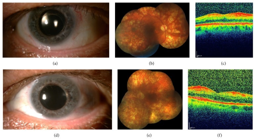 Ocular ischemic syndrome clinical findings: anterior segment, fundus photograph, and OCT images