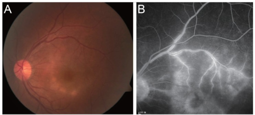 Fundus photograph (A) and fluorescein angiography (B) of a syphilitic <b>posterior uveitis</b> case at presentation. (A)