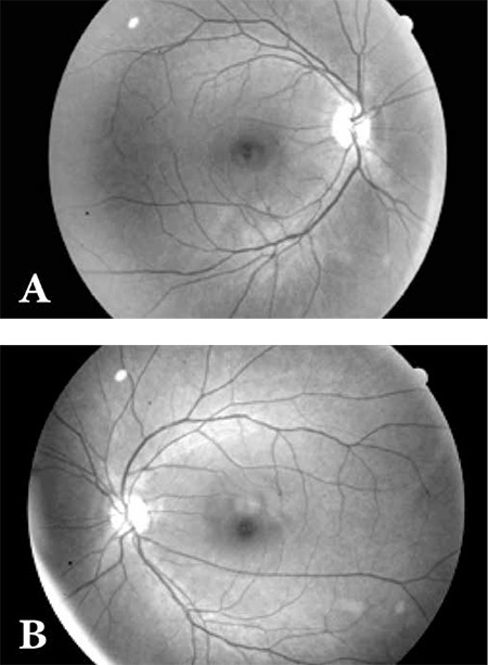 A 62 year old female patient had undergone total thyroidectomy and neck dissection due to follicular thyroid carcinoma 6