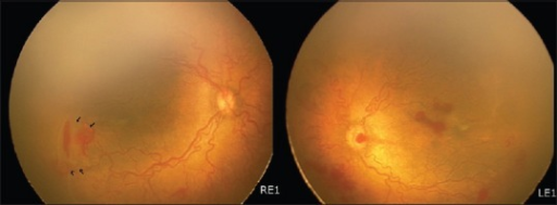 RetCam images at presentation showing Hybrid form of <b>retinopathy of prematurity</b>, zone 1 disease in the right eye,