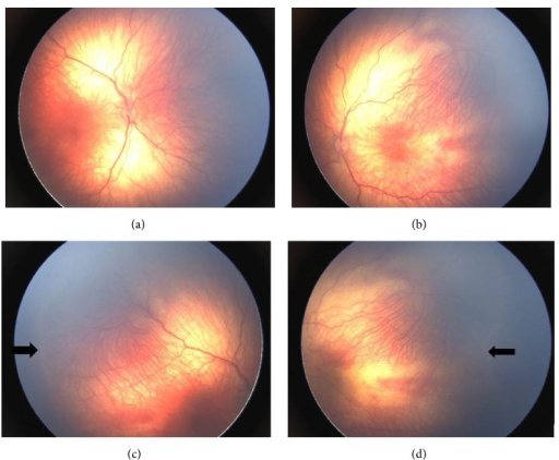 ROP Stage 1 demarcation line in Zone II, arrows indicating the flat white demarcation line at the junction of vascularized and avascular retina
