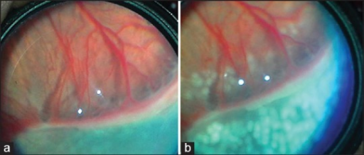 ROP Stage 3 with plus disease in Zone II, showing ridge with extraretinal fibrovascular proliferation before and after laser treatment