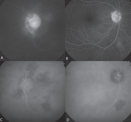 A, Late-phase fluorescein angiogram OS showing <b>optic</b> disc leakage secondary to uveitis. B, Late-phase fluorescein