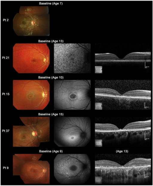 Color fundus photographs, autofluorescence, and spectral-domain optical coherence tomographic images of 5 representative