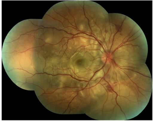 Clinical image of the right fundus of a patient presenting with a serous retinal detachment 4 weeks after penetrating oc
