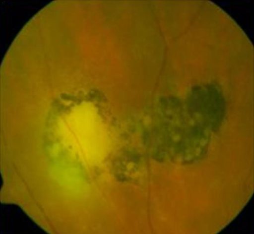 Fourth reported reactivation of toxoplasmic <b>retinochoroiditis</b> in patients RA, No. 9.