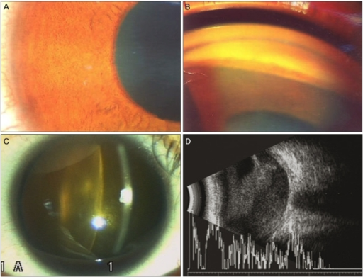 <b>Ophthalmologic</b> findings after stereotactic radiosurgery. (A) The slit lamp examination shows neovascularization o