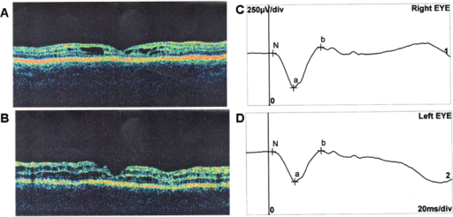 OCT and ERG results of patient 2. A: OCT image of the right eye showing foveal cystic <b>retinoschisis</b>. B: OCT image