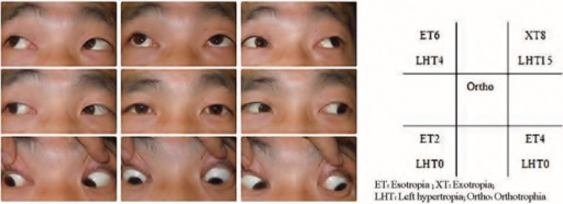 Clinical photograph of 9 diagnostic positions before operation showing limitation of elevation in adduction
