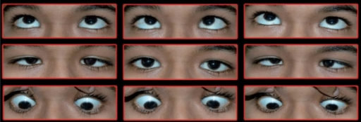 Clinical picture of case showing nine gazes
