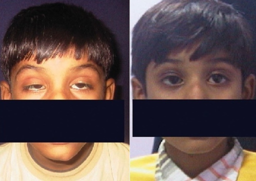 left: External photograph of the child showing severe bilateralptosis. right: The picture on the right shows the postope