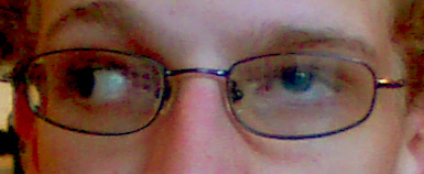 Duane retraction syndrome showing limited abduction