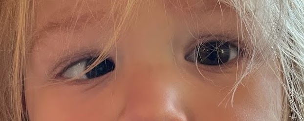 Infantile esotropia showing inward turning of the eye