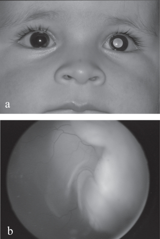 (a) Left <b>leukocoria</b> in a 1 year-old boy with unilateral retinoblastoma. (b) Exophytic retinoblastoma with total r