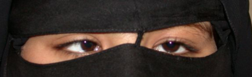 Patient with infantile esotropia with convergence excess, shown fixating with the left eye