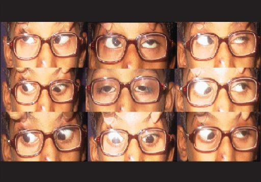 Extraocular movements preoperatively illustrating the 4+superior oblique overaction