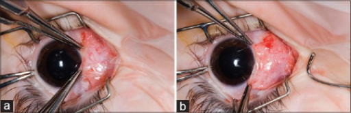 (a) Inadvertent advancement of the plica semilunaris during closure of a limbal incision: (a) Appearance of the medial a