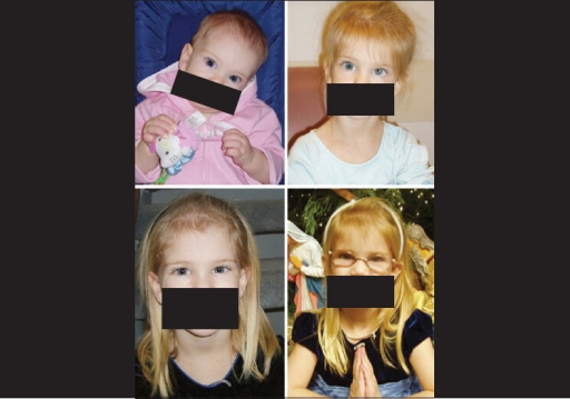 Pre-and post-operative head and eye profile picture of case number 2 showing the elimination of head tilt